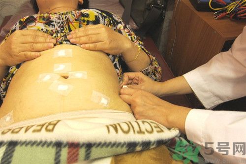 针灸埋线减肥效果好吗,针灸减肥效果好还是埋线减肥效果好 针灸埋线减肥效果好吗,针灸减肥效果好还是埋线减肥效果好