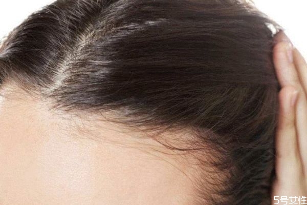 怎么不让发际线后移,发际线往上移怎么办