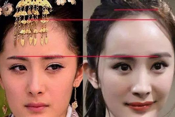 发际线高如何恢复,14岁发际线可以自行恢复吗