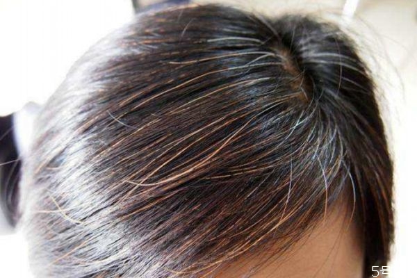 如何减少白头发的生长,怎么才能没有白头发