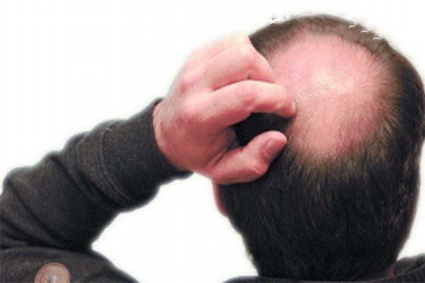 斑秃脱发严重的原因是什么,斑秃的脱发为