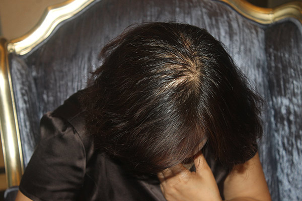 脱发是什么原因引起的女性,什么原因会造成脱发