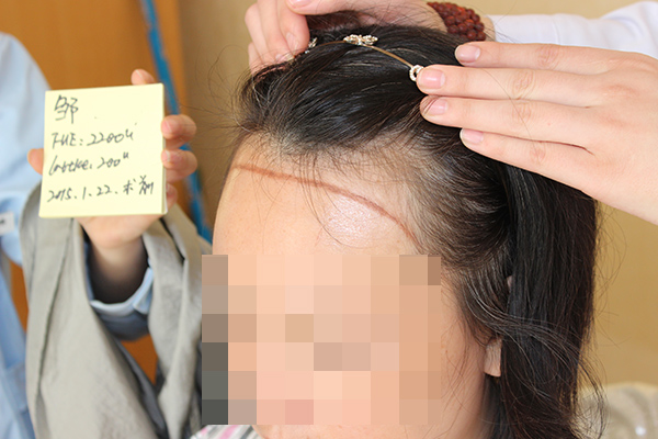 女性掉头发厉害怎么办,掉头发很厉害怎么办