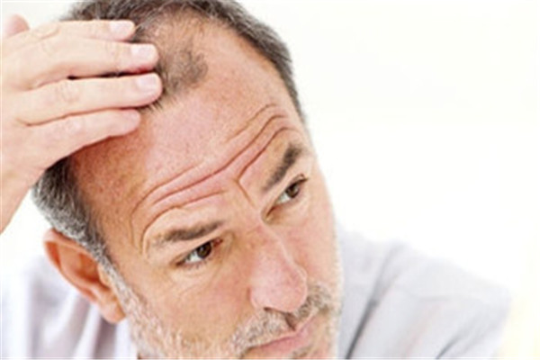 脱发是因为缺少什么维生素,脱发是不是缺维生素是些什么症状呢?