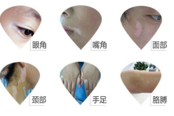 为什么有白癞风,早期白癞风是怎么引起的