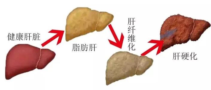 脂肪肝适合高蛋白吗,脂肪肝吃高蛋白好吗