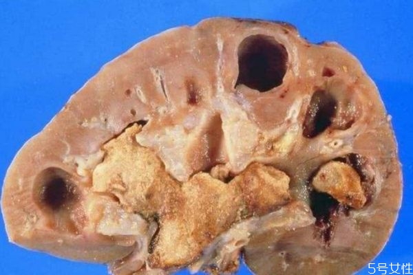 肾结石多大需要碎石治疗?,多大肾结石需要碎石