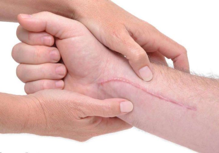 伤口留疤的原因,什么样的伤口会留疤