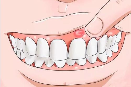 口腔溃疡为什么反复发作,口腔溃疡老是复发是什么原因