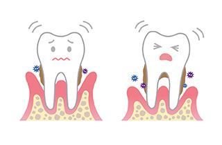 牙周炎要注意什么饮食,牙周炎应该注意什么
