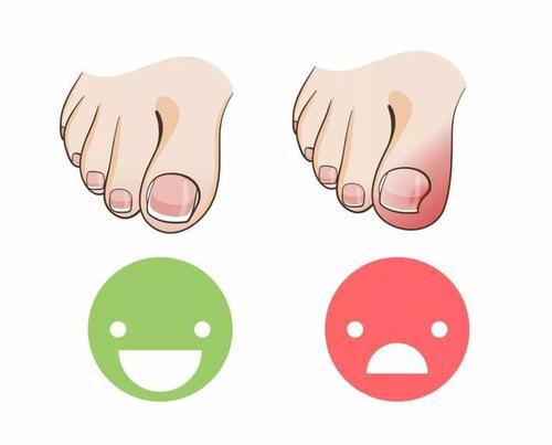 嵌甲能根治吗,为什么嵌甲始终不能根治