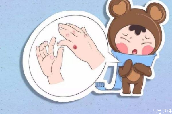 冻疮有什么危害,冻疮是咋样的