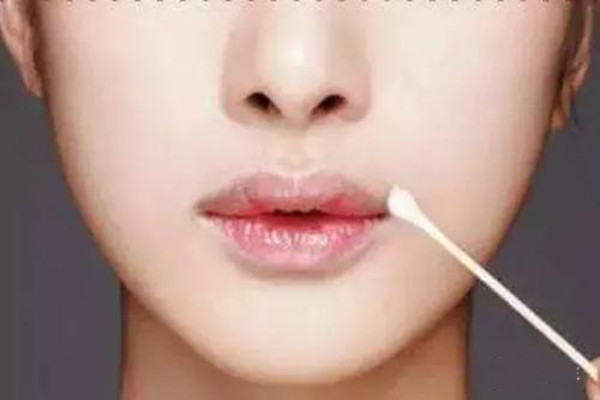 嘴角起泡要注意什么,嘴角起泡用什么药