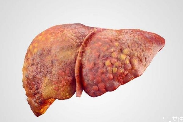 为啥会得肝硬化,什么情况下会得肝硬化 为啥会得肝硬化,什么情况下会得肝硬化