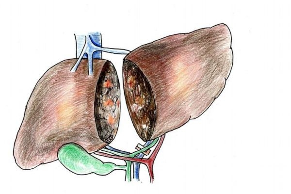肝硬化有哪些危害,肝硬化的危害有多大