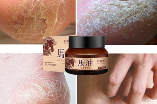 季节性手脱皮怎么治疗,季节性手蜕皮怎么回事?怎么治疗?