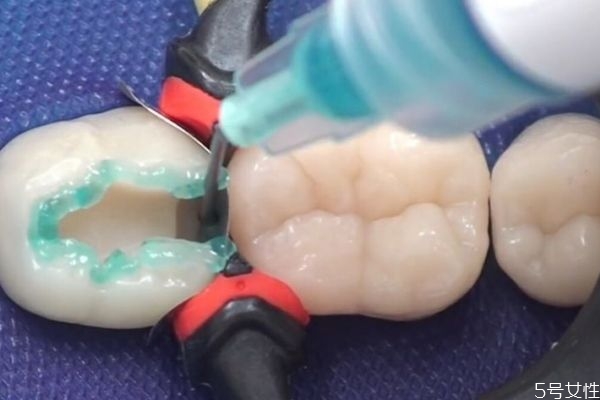 牙缝太大有什么危害,什么原因会导致牙缝越来越大