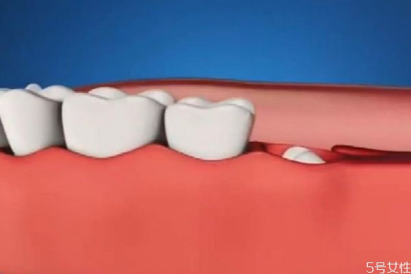 有多少人需要拔智齿,所有人都要拔智齿吗