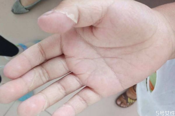 猩红热是什么症状,猩红热主要症状是什么