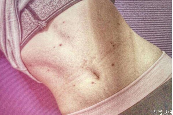 天花是什么原因引起的,天花是怎么引起的 天花是什么原因引起的,天花是怎么引起的