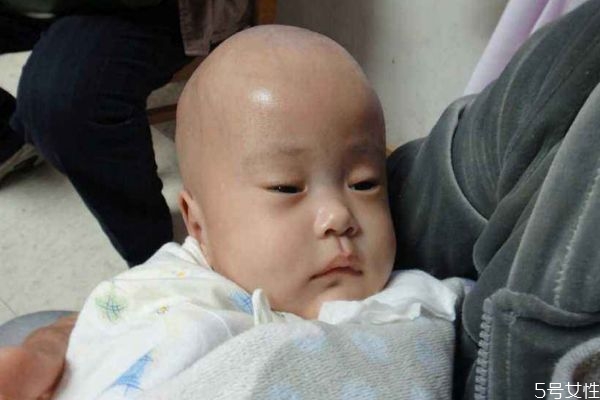 为什么会有脑积水,为什么会导致脑部积水