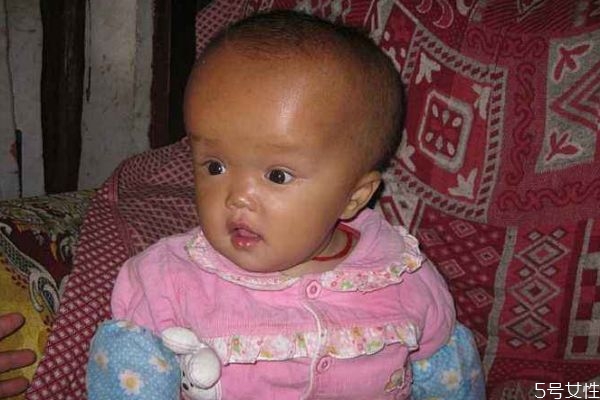 脑积水的危害,脑部积水有什么危害