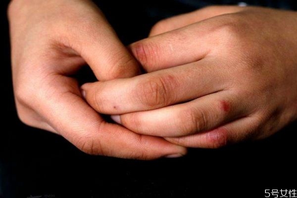 预防冻疮的方法有哪些,怎么可以预防冻疮