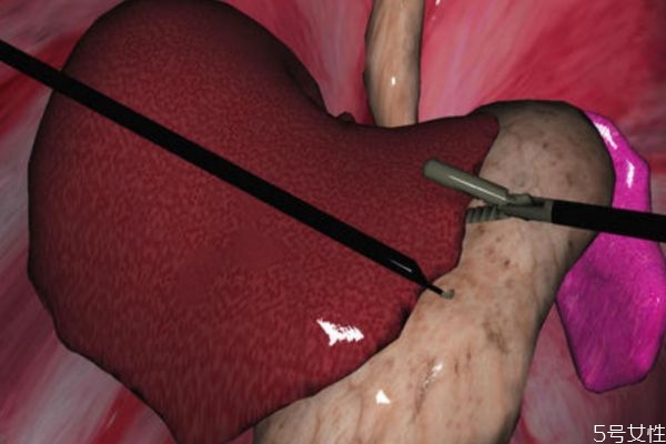 肝上长囊肿对人体有什么危害,肝囊肿破了会有什么危害