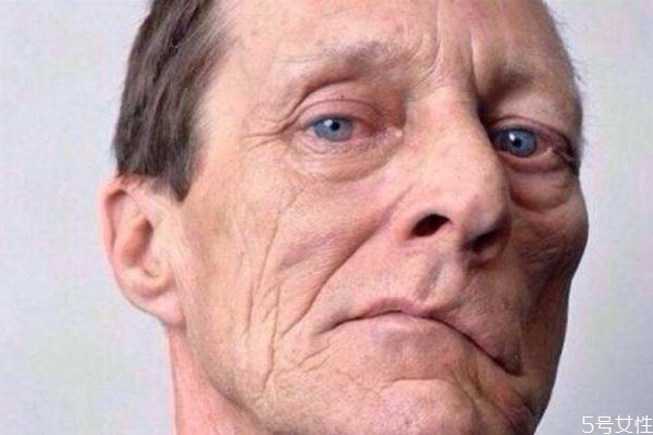 冬天面瘫是什么原因引起的,为什么冬天容易面瘫