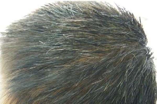 少年白头发吃什么好,少年白吃什么东西才吃得好