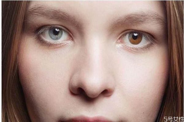 瞳孔异色症怎么得,瞳孔异色症对视力有影响吗 瞳孔异色症怎么得,瞳孔异色症对视力有影响吗