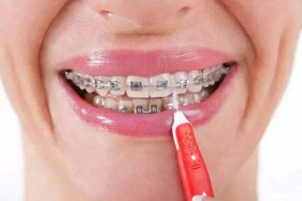 带牙套有啥用,牙套有作用吗