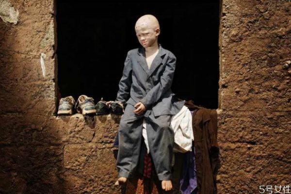 白化病有什么危害吗,什么叫白化病严重吗