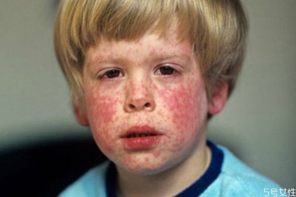 为什么会引起风疹这个病?,为什么得风疹