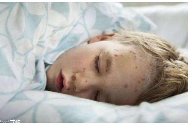 水痘有啥危害,得水痘的危害有多大 水痘有啥危害,得水痘的危害有多大