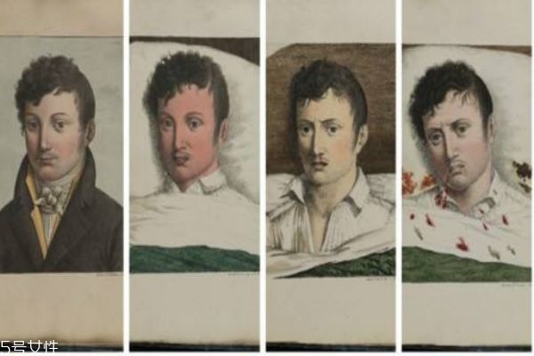 黄热病的症状是什么,黄热病为什么叫黄热病 黄热病的症状是什么,黄热病为什么叫黄热病