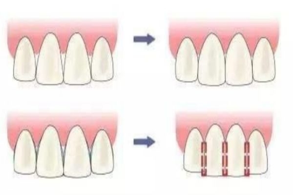 牙齿不好看除了矫正还有什么办法,牙齿不好看怎么整