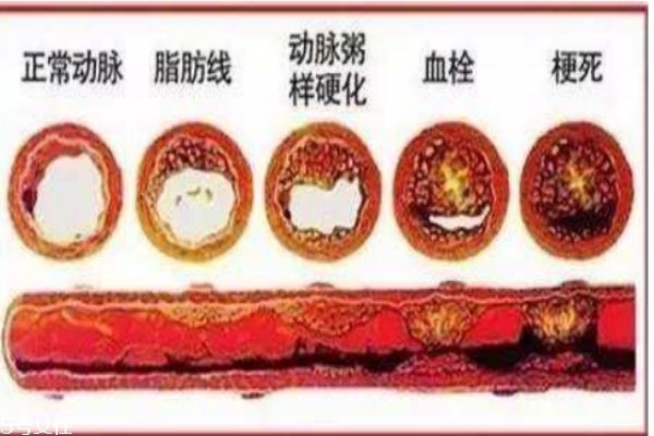 高血脂的危害是什么?,高脂血症有什么危害