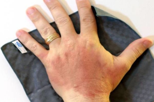 烫伤后的应急处理方法,烫伤的应急处理方法