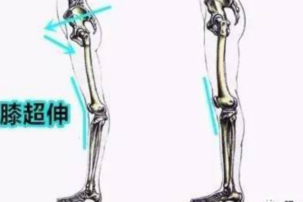 长期膝关节的超伸会导致什么,膝关节超伸的危害 长期膝关节的超伸会导致什么,膝关节超伸的危害