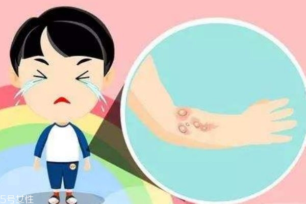 被开水烫伤后起水泡多久能好,烫伤后起水泡多久能好 被开水烫伤后起水泡多久能好,烫伤后起水泡多久能好