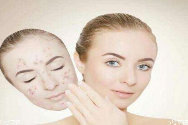 解决激素脸,如果脸是激素脸了怎么样治疗 解决激素脸,如果脸是激素脸了怎么样治疗
