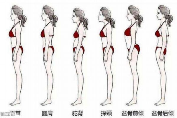 驼背的表现,驼背是怎么引起的