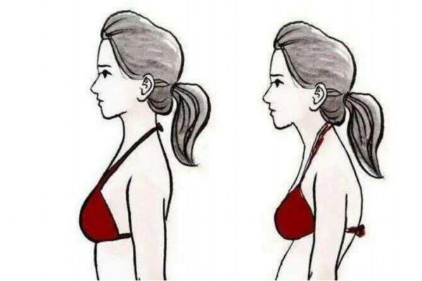 如何有效预防驼背,改善驼背最有效办法