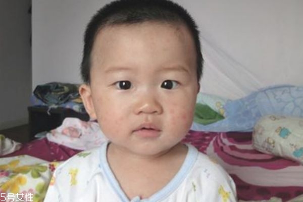 幼儿急疹的特点是什么,幼儿急疹的临床特点