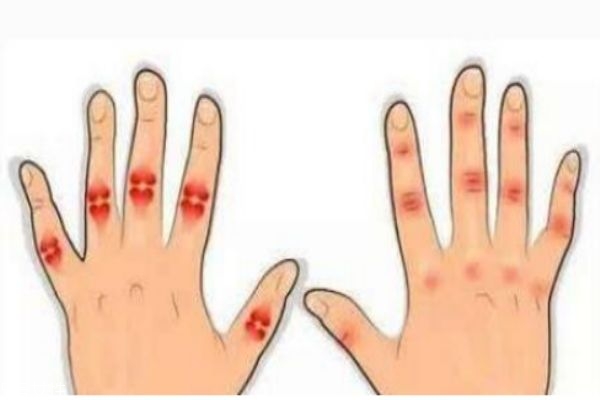 风湿病的预防方法,怎么预防风湿病的方法