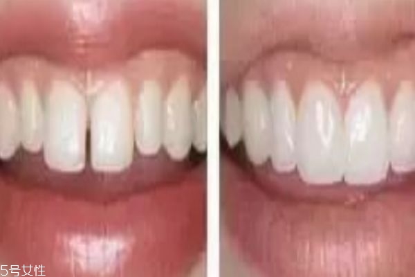 牙齿缝隙大什么原因,牙齿缝隙越来越大是什么原因造成的