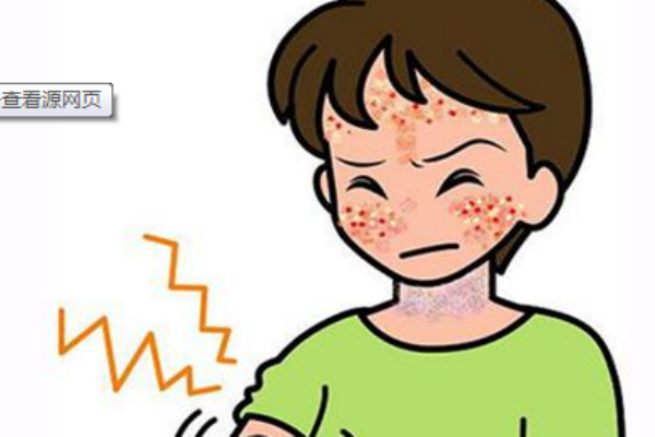 神经性皮炎是什么原因引起的,神经性皮炎是什么症状