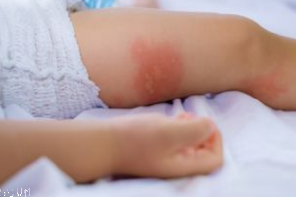 怎么预防湿疹复发,预防湿疹的方法