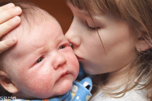 引起婴儿湿疹的原因有哪些?,孩子出湿疹是什么引起的 引起婴儿湿疹的原因有哪些?,孩子出湿疹是什么引起的